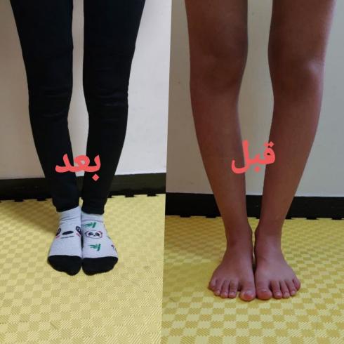 کلینیک درمان پای پرانتزی در سعادت اباد