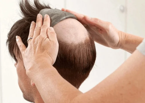 ترمیم و پروتز مو _ کلینیک موسان