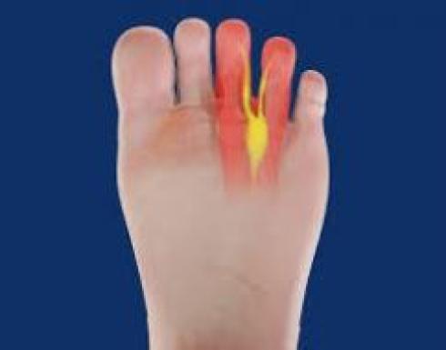 درد کف جلوی پا (مورتون نوروما ) - اهواز