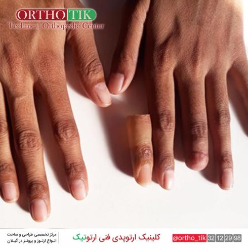 ساخت انگشت مصنوعی، دست مصنوعی، پای مصنوعی