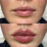 تزریق ژل لب با متدد روسی عروسکی و طبیعی | کلینیک لارا