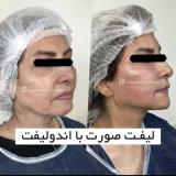 لیفت صورت و گردن با دستگاه اندولیفت آمریکایی