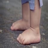 مرکز درمان صافی کف پای کودکان در جزیره قشم