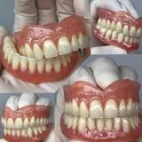 لابراتوار دندانسازی ساخت دندان مصنوعی ژله ای