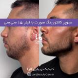 پروتزفک زاویه سازی فک مادلینگ صورت کلینیک زیبایی لارا
