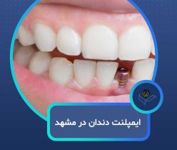 ایمپلنت دندان در مشهد با اقساط بلندمدت و شرایط ویژه