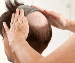 ترمیم و پروتز مو _ کلینیک موسان